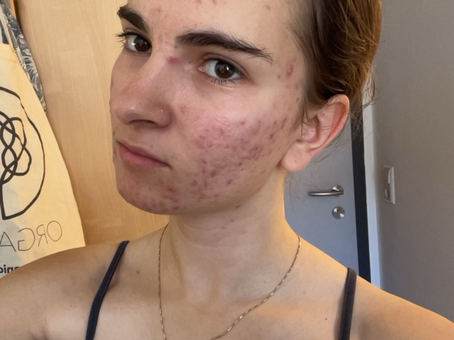 sarah akne
